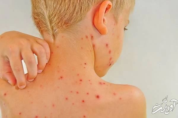 واکسن آبله مرغان برای کودکان پیشگیری آبله مرغان